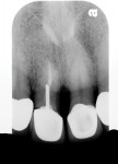 Figure 1 Radiograph of typical oblique root fracture with metal post.