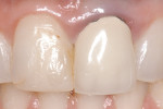 Figure 3 Example of the gingival shadowing that can occur when using a metallic post.