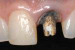 Figure 4 Root darkening due to endodontic treatment with metallic post.