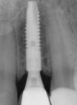 Figure 1 Astra Tech implant with unique crestal microthreads contributing to ideal crestal bone
levels.
