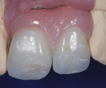 A screw-retained implant fixed partial denture showing ideal implant placement for
lingual screw access.