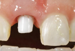 Figure 14  Image of custom zirconia implant abutment made with the Procera system.