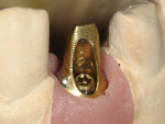 A custom Gingihue® abutment manufactured by Atlantis
Components.