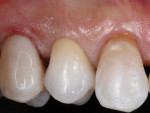 The definitive restoration is cemented with a resin-modified glass-ionomer cement. This cement provides good retention but remains slightly soluble should any cement be retained subgingivally.