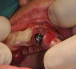 Once the implant is properly aligned, it is installed in the extraction socket using SIMPLANT guided surgery.