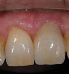 The final result—healthy soft tissue and an esthetic emergence profile.