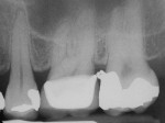 Figure 8  Radiographic view of a mesial overhang on an amalgam restoration in the second maxillary molar.