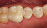 Figure 6. After picture of a SonicFill restoration that was place by one of the author’s expanded-duty dental assistants.
