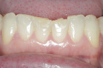 Figure 5 Lower incisors showed both thinning and significant shortening due to the constricted chewing pattern.