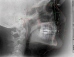 Figure 7 Cephalometric tracing demonstrating high interincisal angle (156°), common with a constricted chewing pattern.