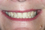 Figure 8 Full smile, demonstrating gingival papilla but not the gingival zeniths of the anterior teeth.