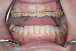 Figure 11 After advancement of upper incisors was accomplished, direct resin was placed as a transitional material to aid in the completion of orthodontic alignment.