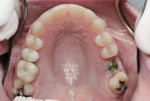 Figure 13 Placement of healing cuff on implant after completion of orthodontics.