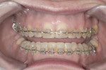 Figure 12 Completion of orthodontic alignment, after placement of brackets on the transitional bonding.