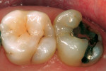 Figure 11  Preoperative condition of tooth No.15.