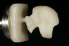 Fig 16. Indirect denture conversion—The indexed provisional prosthesis is modified for passive attachment of the posterior titanium cylinders to the prosthesis using heat-cured acrylic under pressure. This process is repeated for the anterior indexed implants, leading to a higher quality provisional with increased strength.