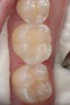 Figure 6 The final disto-occlusal restoration on tooth No. 30.