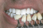 Figure 3 Educate
patient with extremely white teeth in contrast to light shades of the vita classical
shade guide.