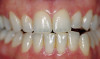 Fig 17. Pre-treatment smile of patient with terminal dentition.