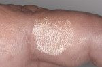 Figure 4 Chemical skin burn from 30% hydrogen peroxide.