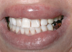 Figure 5 Example of a patient who had a negative response to in-office bleaching with
bleaching lamp, which manifest in a swelling of the unprotected lips.