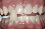 Figure 9 Patient at 1-week post-whitening.