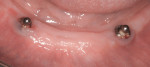 Figure 1 Mucositis around two lower implants supporting a removable denture with ball attachments.