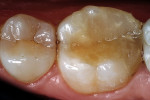 Figure 1  Preoperative occlusal view of a defective composite restoration with recurrent decay on the mandibular left first molar.