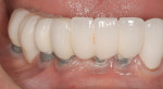 Figure 2 Peri-implantitis around lower implants
supporting a fixed prosthesis. Implant threads are exposed and the gingiva is thin, with a lack of keratinized tissue.