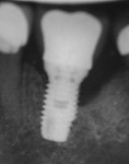 X-ray of posterior implant showing peri-implantitis bone loss on distal.