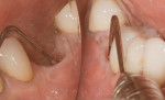 Figure 4 Pocket of 8 to 9 mm on the buccal of the implant after
crown removal.