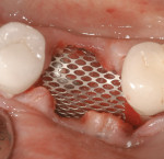 Figure 7 Bone graft is enclosed by a titanium mesh.