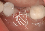 Figure 8 Implant is completely submerged during healing.