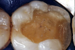Figure 3  Occlusal view of completed onlay preparation design.
