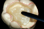 Figure 6  An A-2 shaded opacious dentin layeris placed in the center of the preparation and adapted with a flat-bladed interproximal instrument,and an indention was created around the central artificial core.