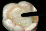 Figure 7  A premeasured reinforcement fiber is completely coated with unfilled resin and adapted into the soft initial opacious dentin layer andcured in the light cup for 2 minutes.
