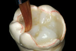 Figure 10  The occlusal planes and ridges were developed with subsequent layers of opacious and translucent A-2 shaded hybrid composite. Each layer was smoothed and contoured with a 3/0 sable brush and cured in the light cup for 2 minutes.