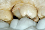 Figure 11  The die was placed onto the Geller working model and the anatomical contour was developed according to the occlusal parameters.