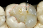 Figure 13  Subsequent layers of incisal, clearshaded hybrid composite were placed over the developed anatomical contours and an infinitesimal amount of orange tint was placed in specific occlusal grooves and the layers were compressed together, creat