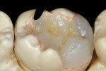 Figure 16a  The final artificial enamel was restored with small increments of incisal, clear-shaded hybrid composite, which was placed over the developed anatomical contours as an occlusal envelope to reproduce form in addition to the optical effects