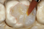 Figure 16c  The final artificial enamel was restored with small increments of incisal, clear-shaded hybrid composite, which was placed over the developed anatomical contours as an occlusal envelope to reproduce form in addition to the optical effects