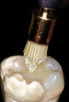 Figure 17a  Silicon carbide-impregnated brushes were used to final polish the occlusal concavities, grooves, and fossae that are difficult to access with other polishing devices.
