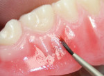 Characterizing the denture base with Ceramage Gum colors.