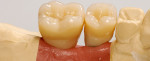 Figure 3. The set-up can be performed with prefabricated teeth, which are cut back to fit the reduced impression posts.