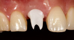 Figures 15 and 16. Straumann Cares abutment in the patient’s mouth.