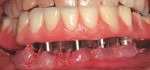 Figure 8  The interim complete denture is secured to the immediate implants 4 hours into the appointment.