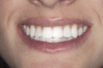Figure 2  Full-smile photo after treatment reveals the smooth texture and natural appearance of the translucent varnish on the teeth.