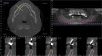 Figure 1 CBCT image of patient illustrating axial view, panoramic view, and cross-section
images of the lower right edentulous mandible. The inferior alveolar nerve has been
identified in purple.