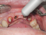 Figure 5 CO2 laser being used for stage II
implant surgical uncovery procedures before impression for abutment fabrication.