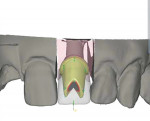 Figure 6 Digital image showing design review for zirconium abutment. Abutment contour
and margin design can be seen through soft tissues.